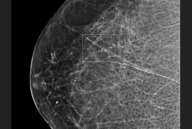 FDA aims to level field on breast-density disclosure to patients