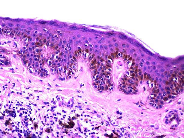 Media Name: melanocytic_nevus-x.jpg