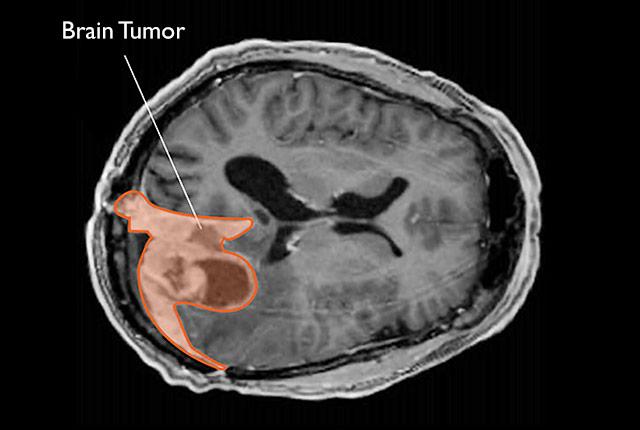 Media Name: meningioma-nci.jpg