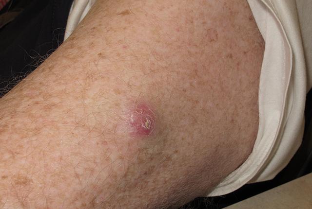 Media Name: merkel_cell_lesion_upper_arm.jpg