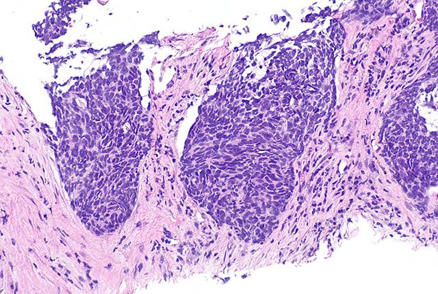 Media Name: non-small_cell_lung_carcinoma_-_intermed_mag.jpg