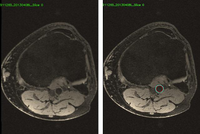 Media Name: poplitealarteryx2.jpg