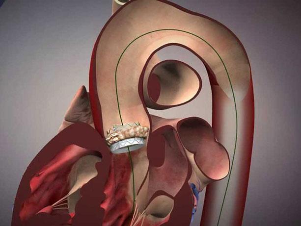 Media Name: tavr.sapien-valve-deploy.jpg