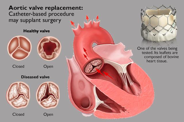 Media Name: xaortic_valve_compilation.jpg