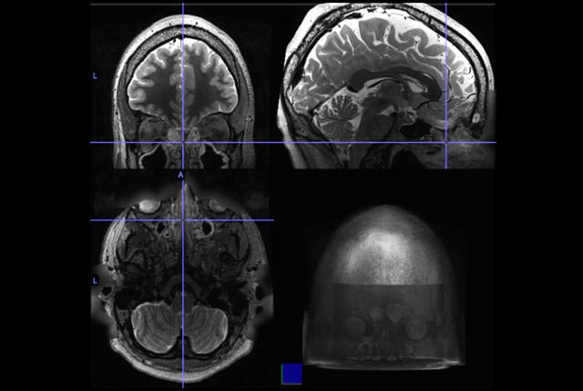 Chronic sinus inflammation appears to alter brain activity – University of Washington Medicine