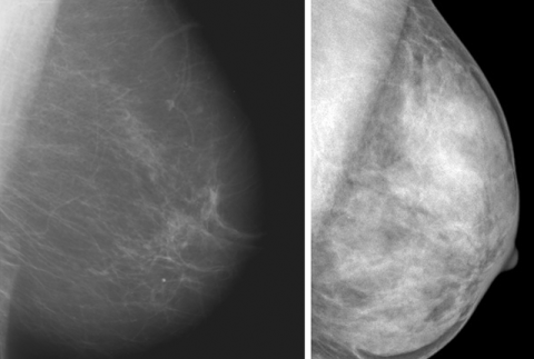 Dense Breast Tissue: What It Means and What to Know