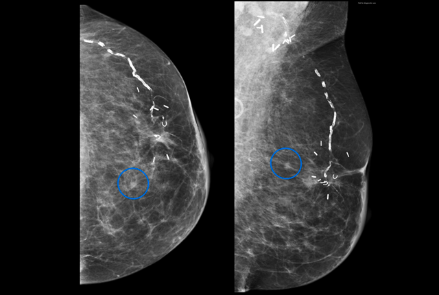 Mammography decline seen among breast cancer survivors - UW