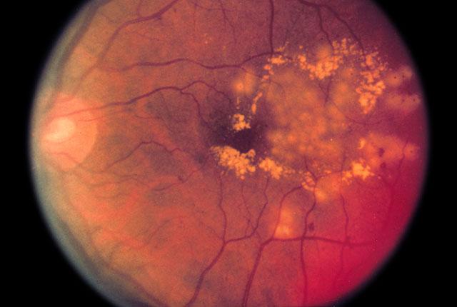 Diabetic retinopathy