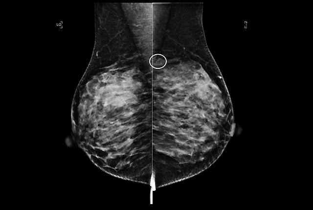 Mammogram - calcifications Information