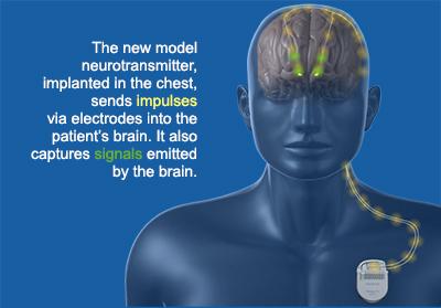 Deep Brain Stimulation (DBS) Videos