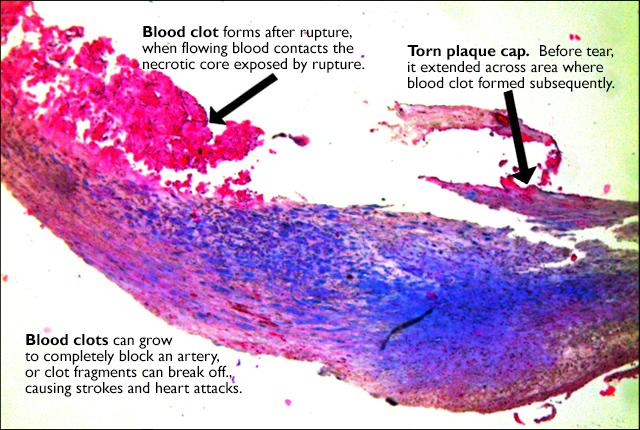 Preventing Plaque Buildup in the Arteries