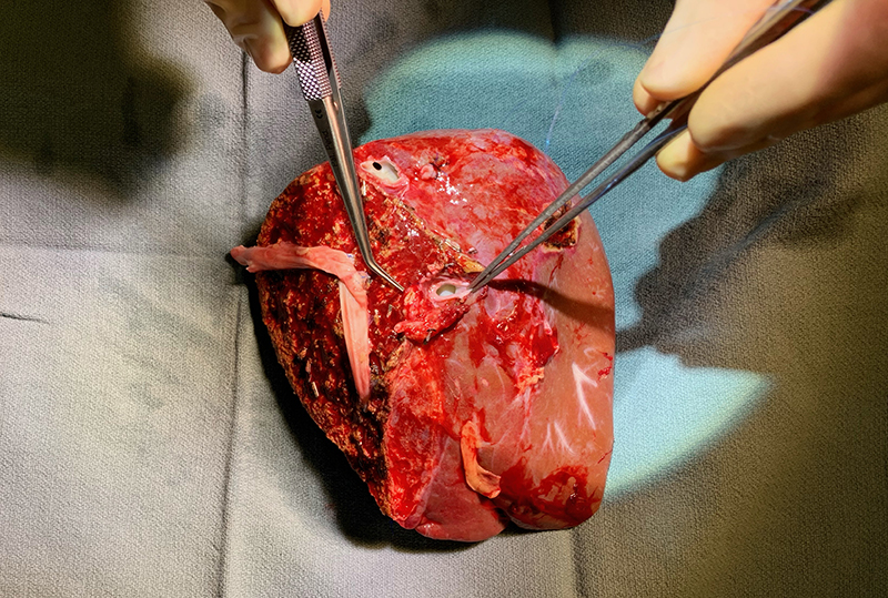Surgeons prepare the right hepatic lobe of Lauren Anderson'